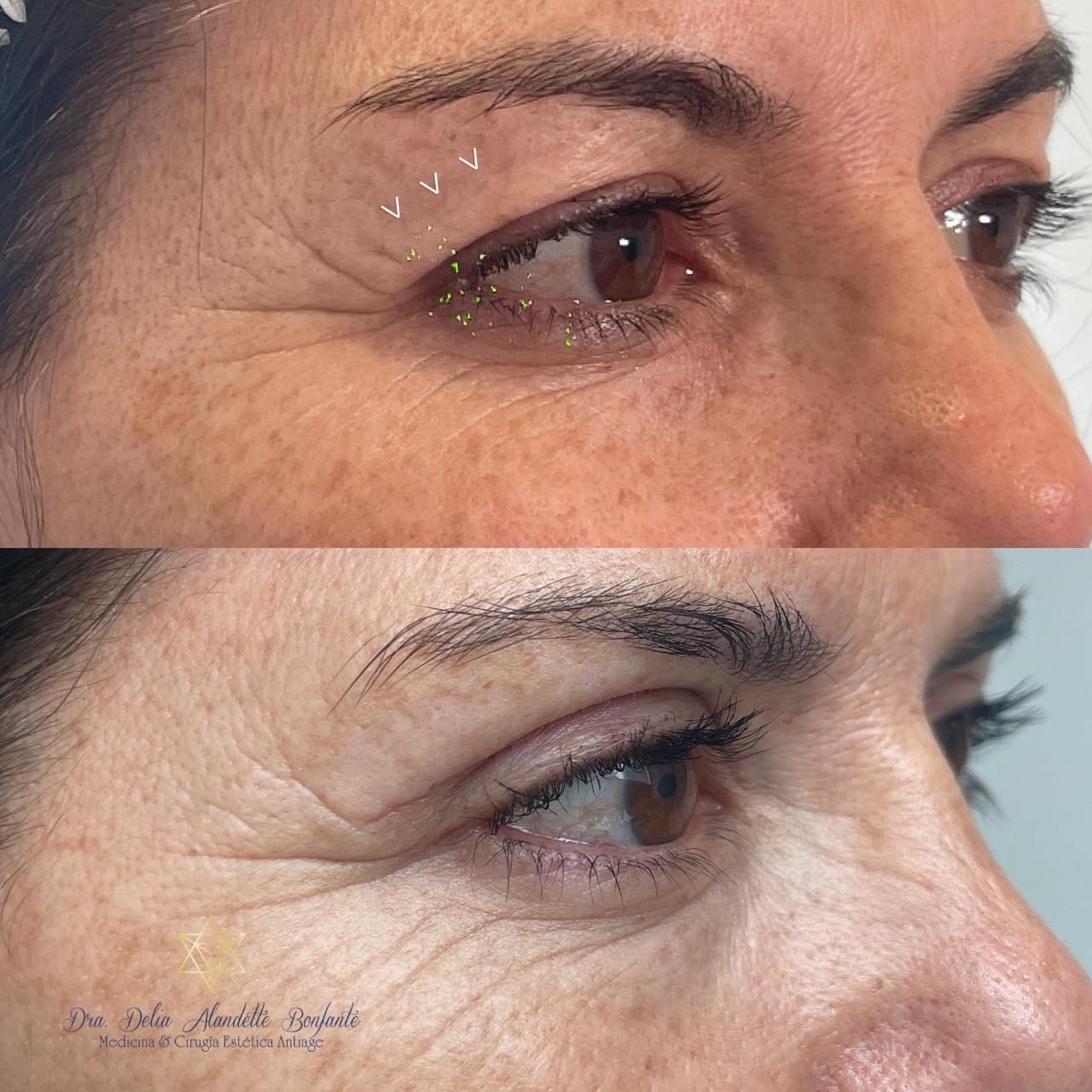 Antes y después de blefaroplastia superior