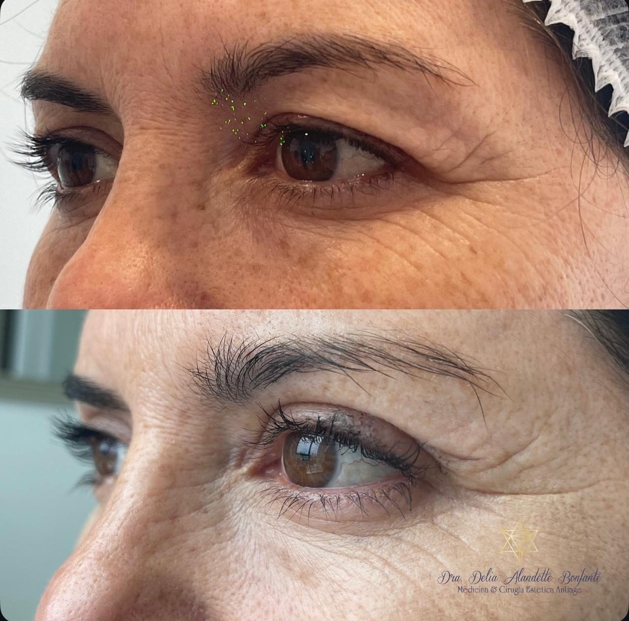Antes y después de blefaroplastia superior