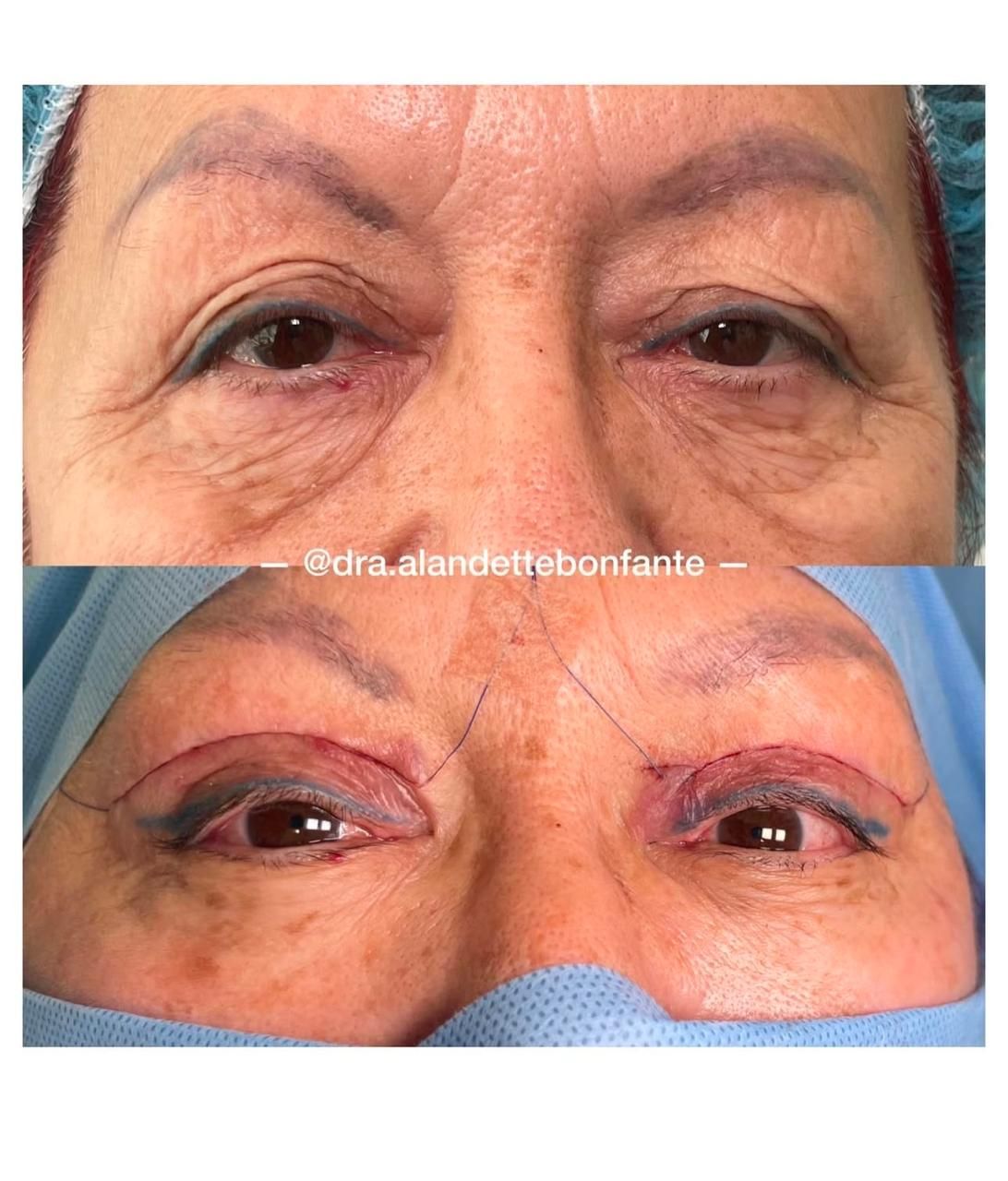 Antes y después de blefaroplastia con lipofilling