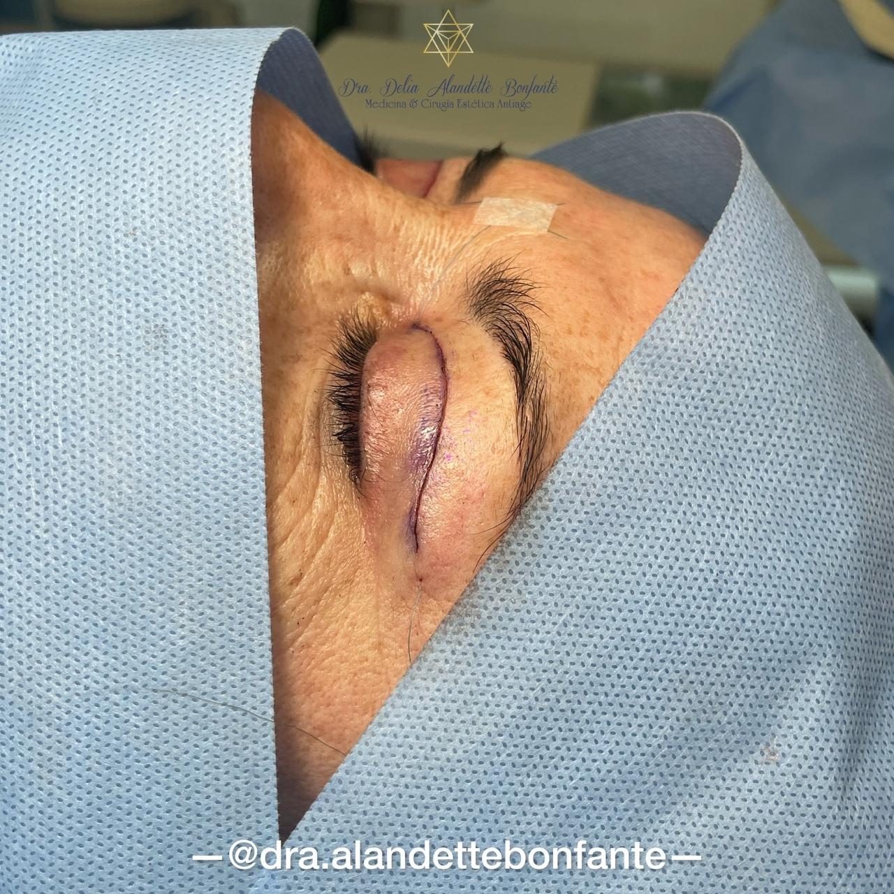 Blefaroplastia superior recién terminada en el pabellón
