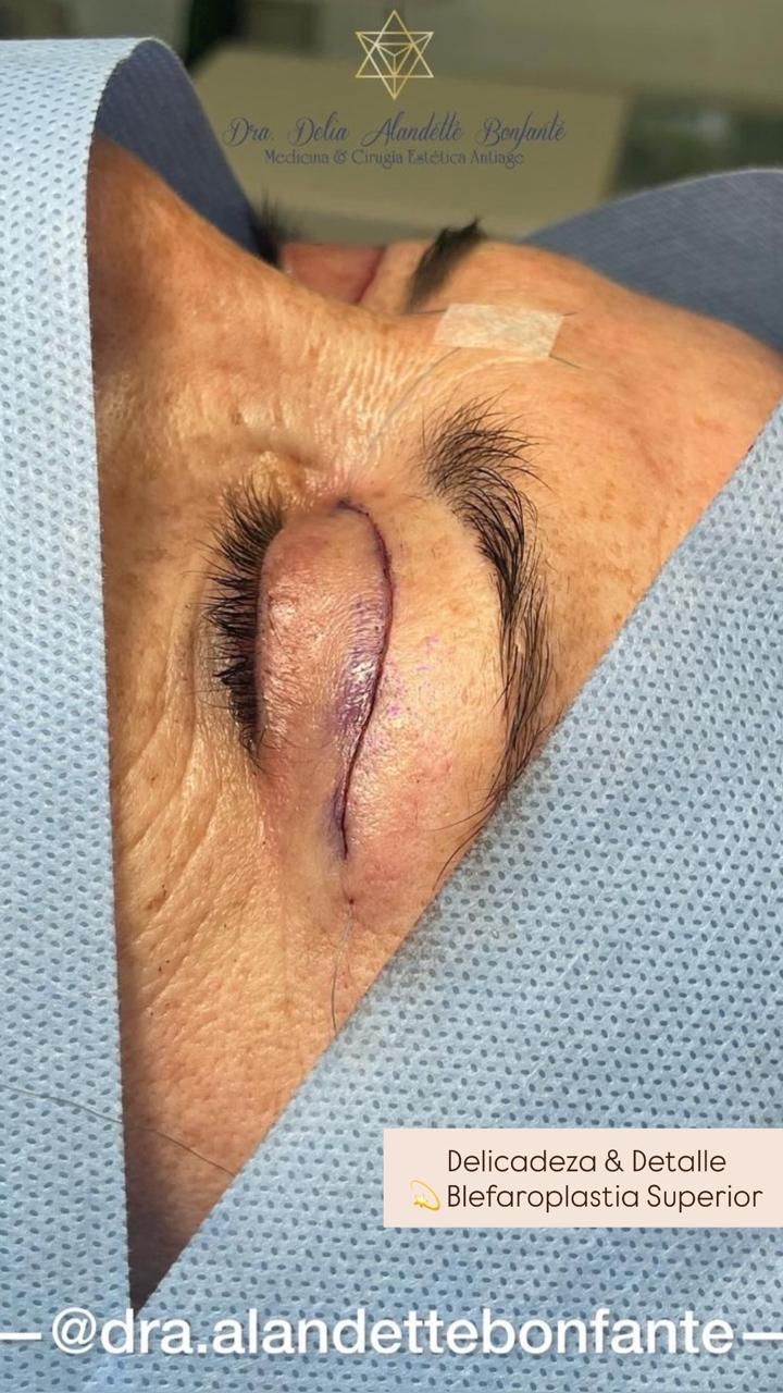 Blefaroplastia superior recién terminada