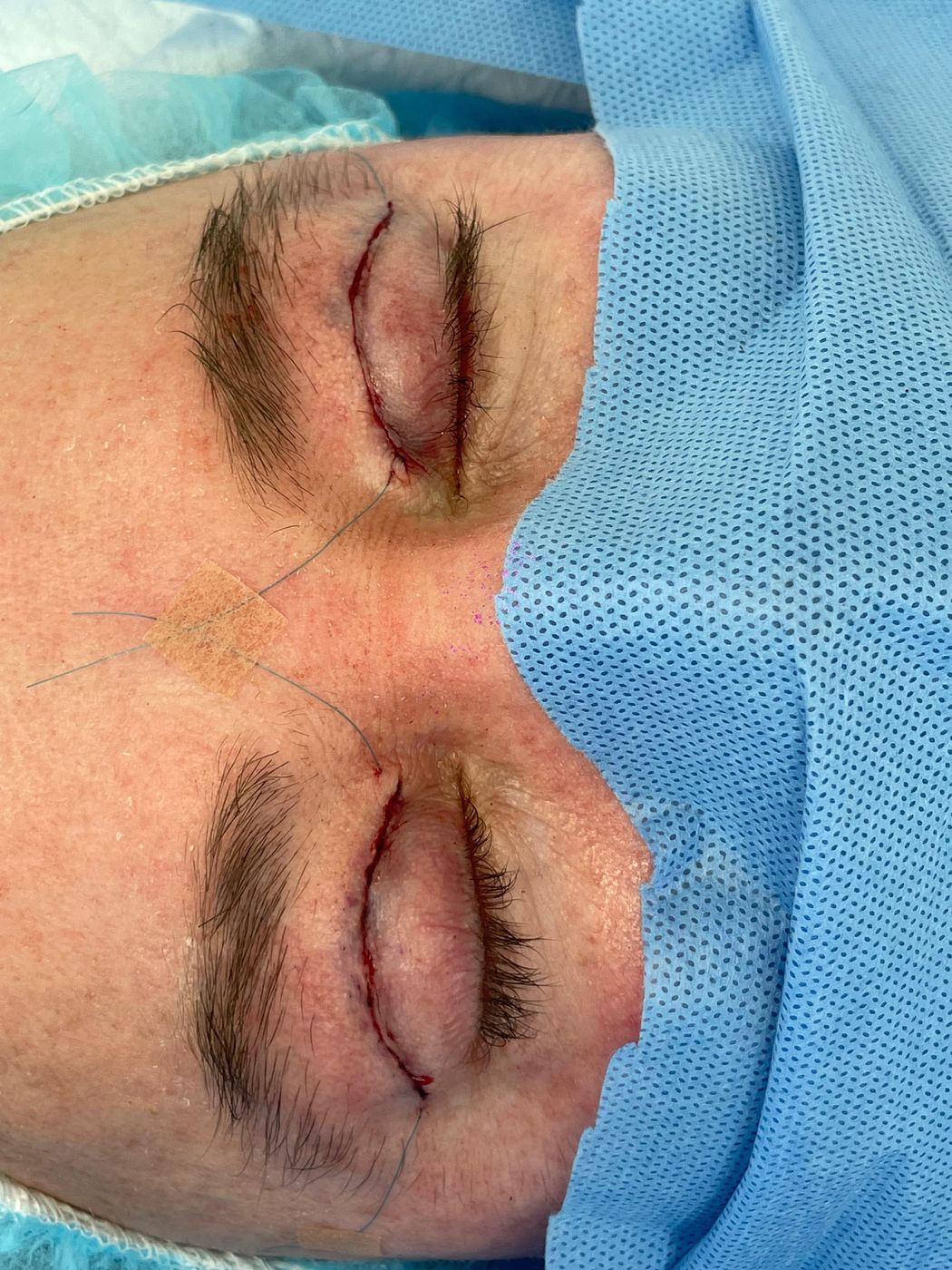 Blefaroplastia superior en ambos párpados, con sutura fina