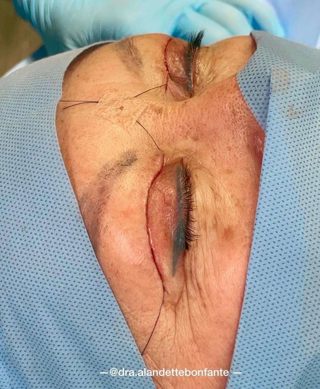 Sutura de una blefaroplastia superior
