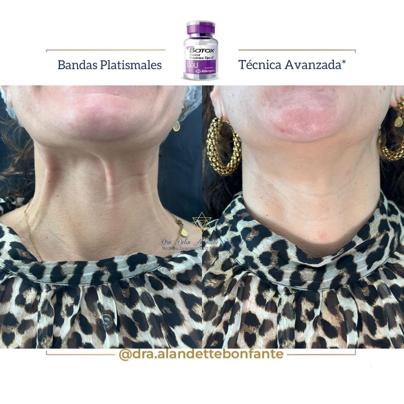 Antes y después de Botox en bandas platismales