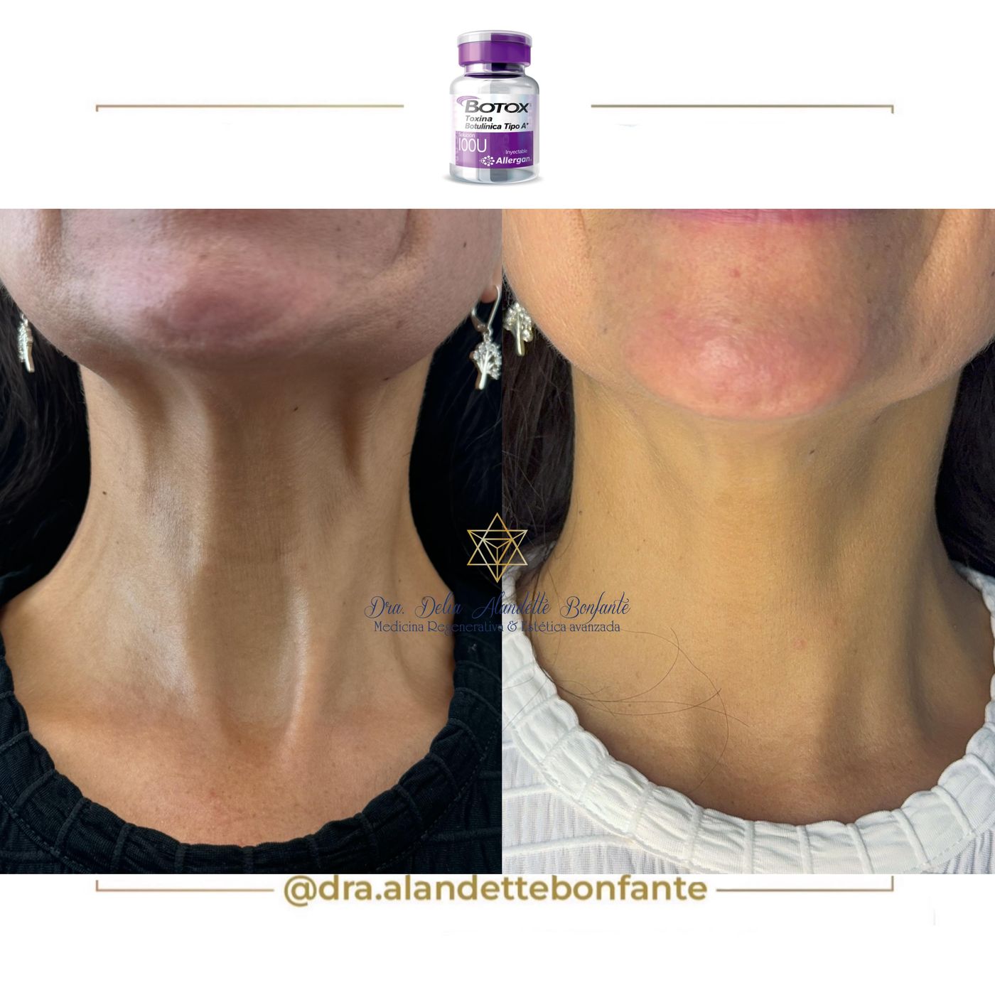 Antes y después de Botox en el cuello