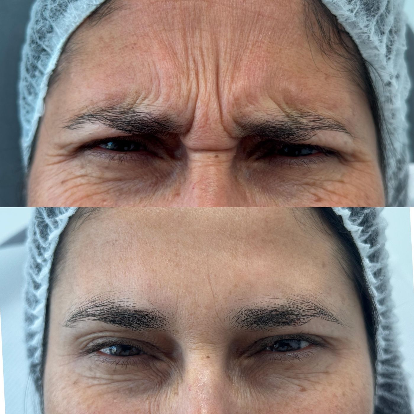 Antes y después de Botox en el entrecejo