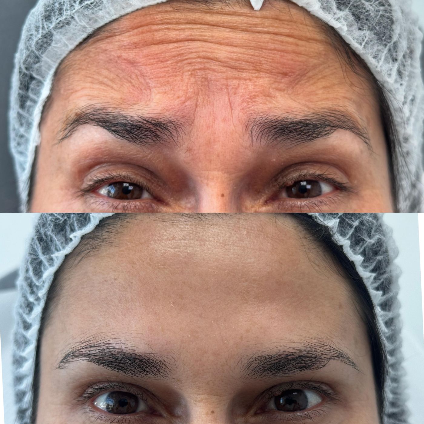 Antes y después de Botox en la frente