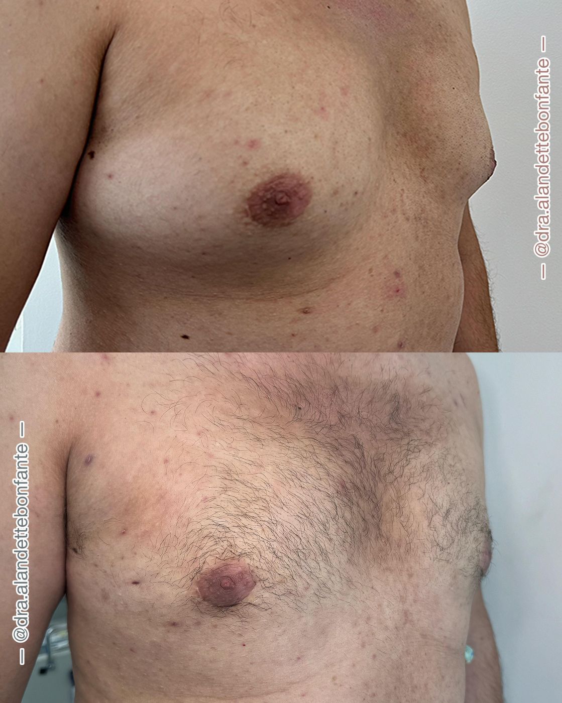 Antes y después de ginecomastia, vista frontal