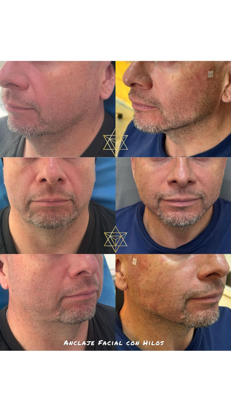 Antes y después de anclaje facial con hilos tensores