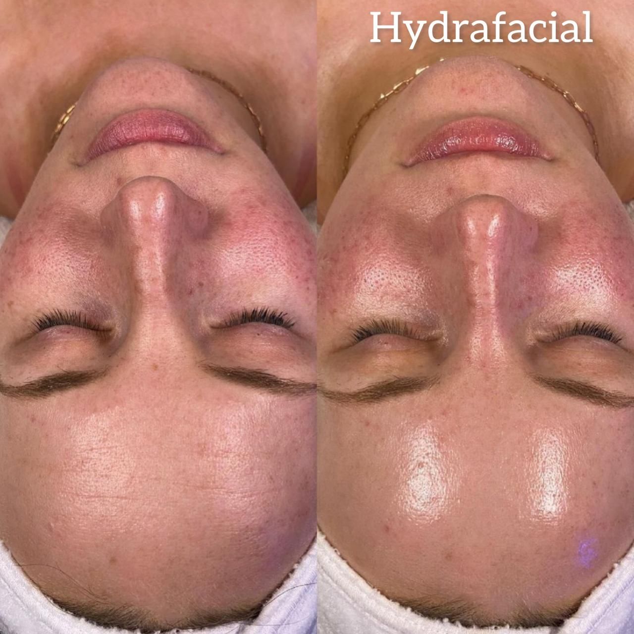 Antes y después de Hydrafacial