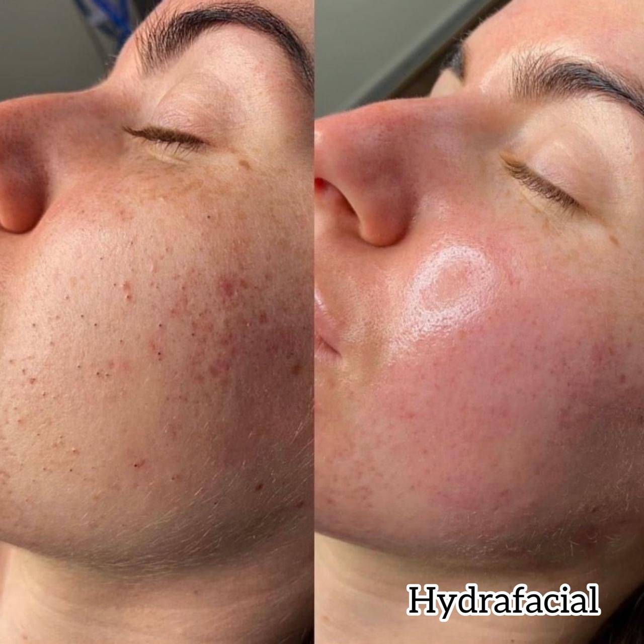 Antes y después de Hydrafacial