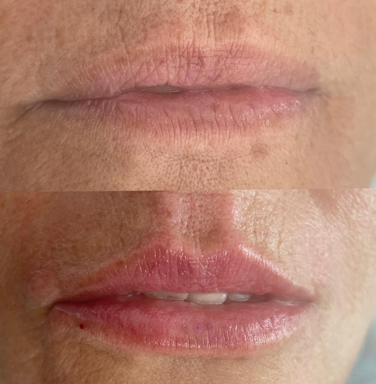 Antes y después de hidratación de labios