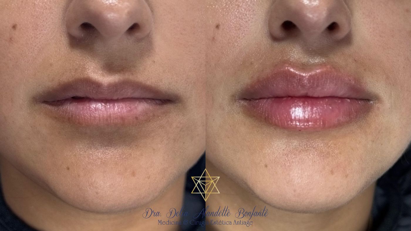 Antes y después de perfilado de labios con ácido hialurónico