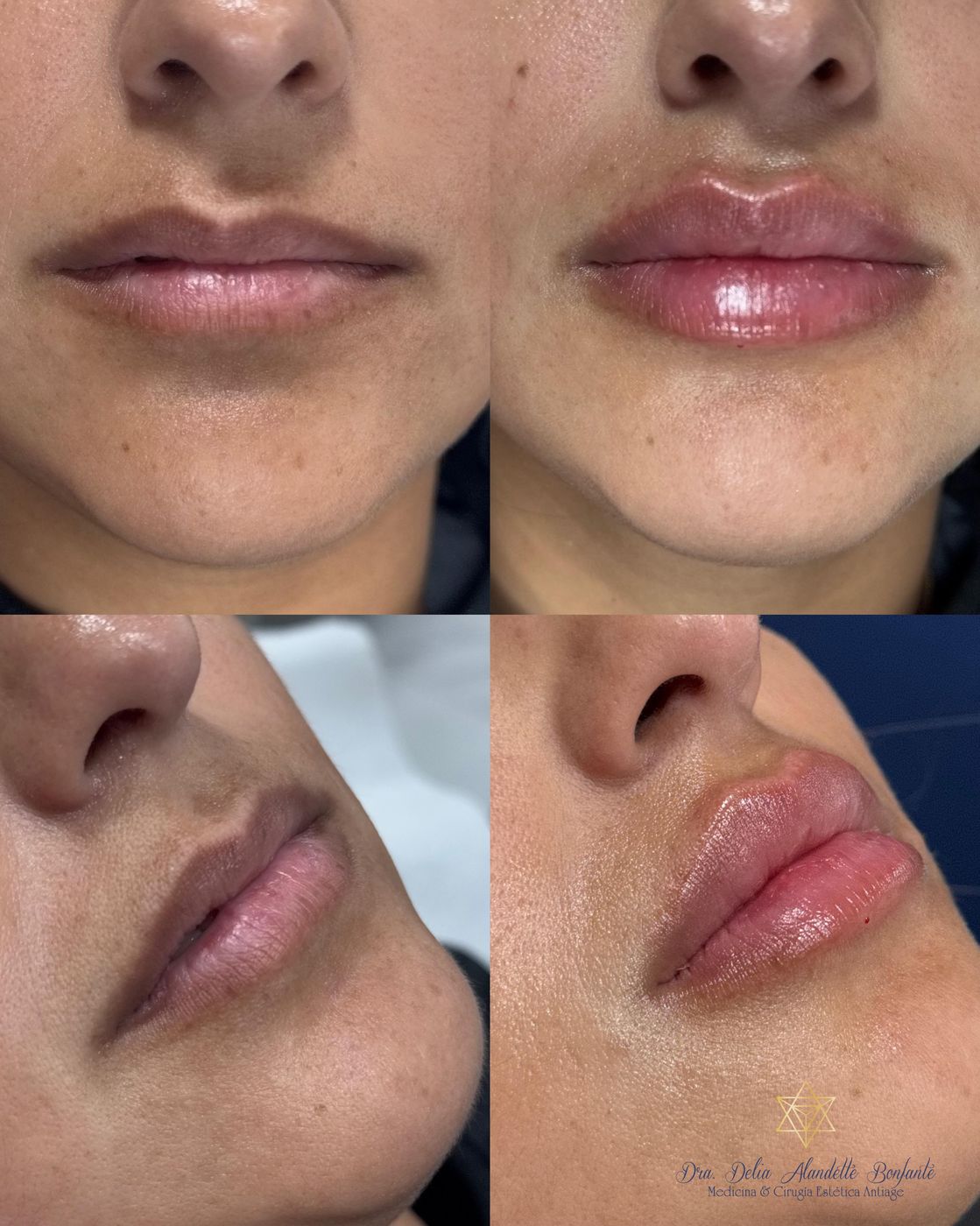Antes y después de perfilado de labios