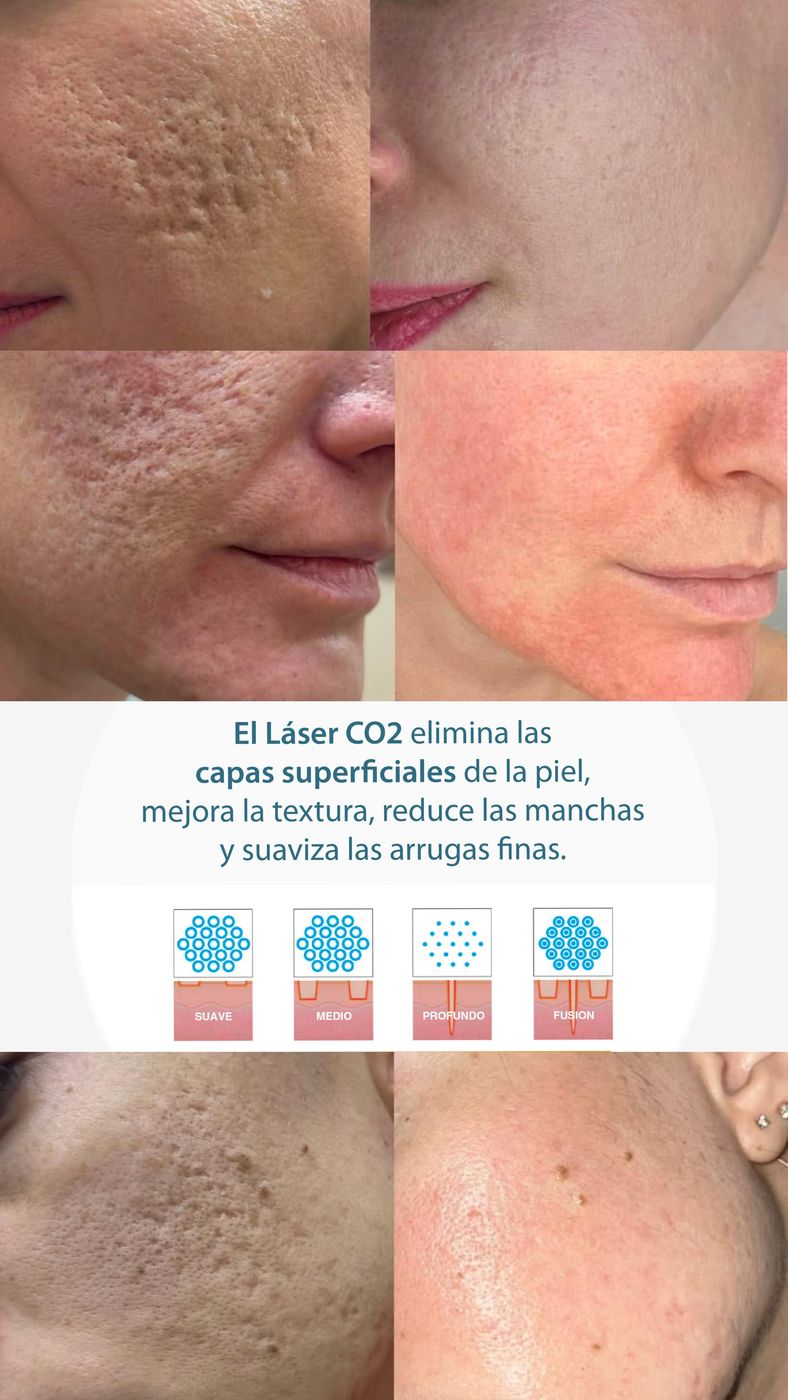 Antes y después de láser CO2 en cicatrices de acné