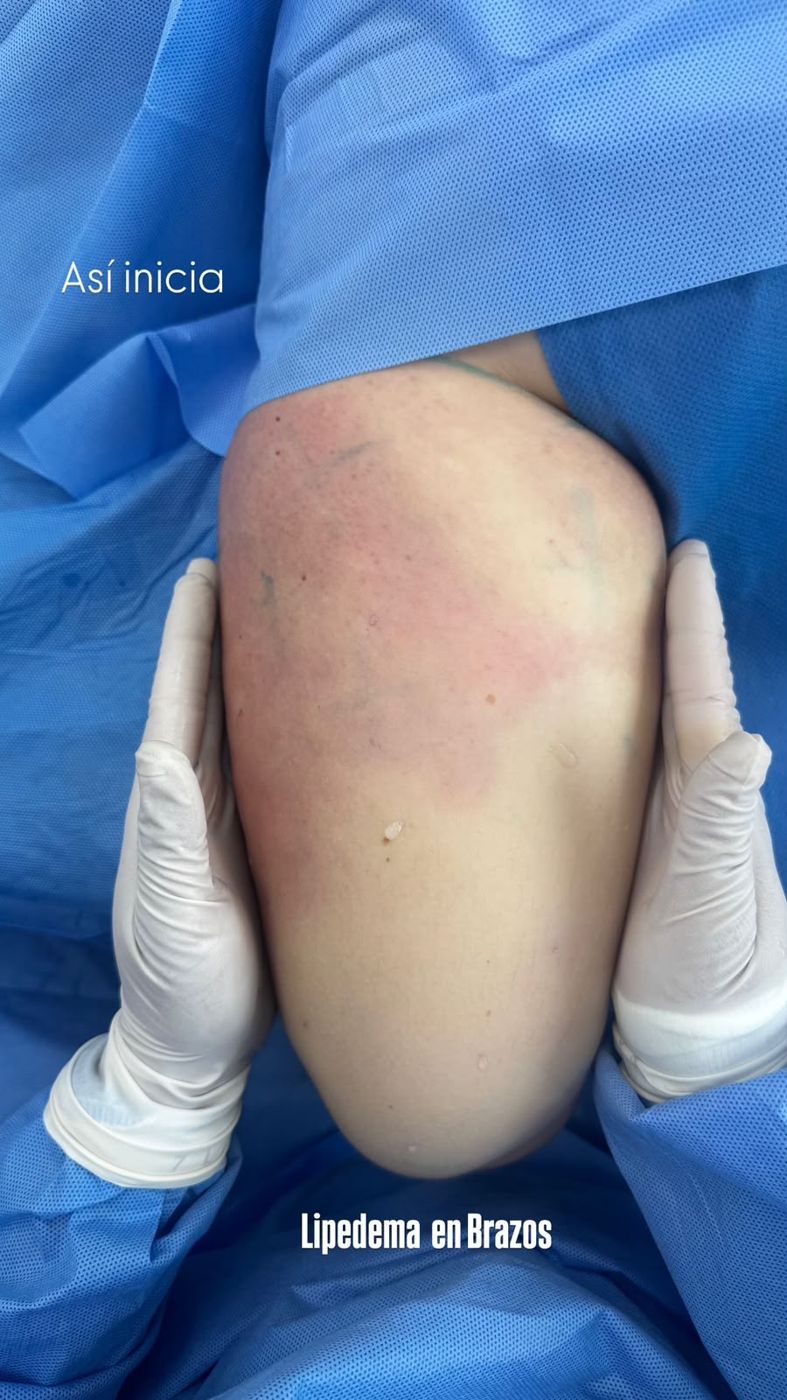 Lipedema en brazos antes del tratamiento