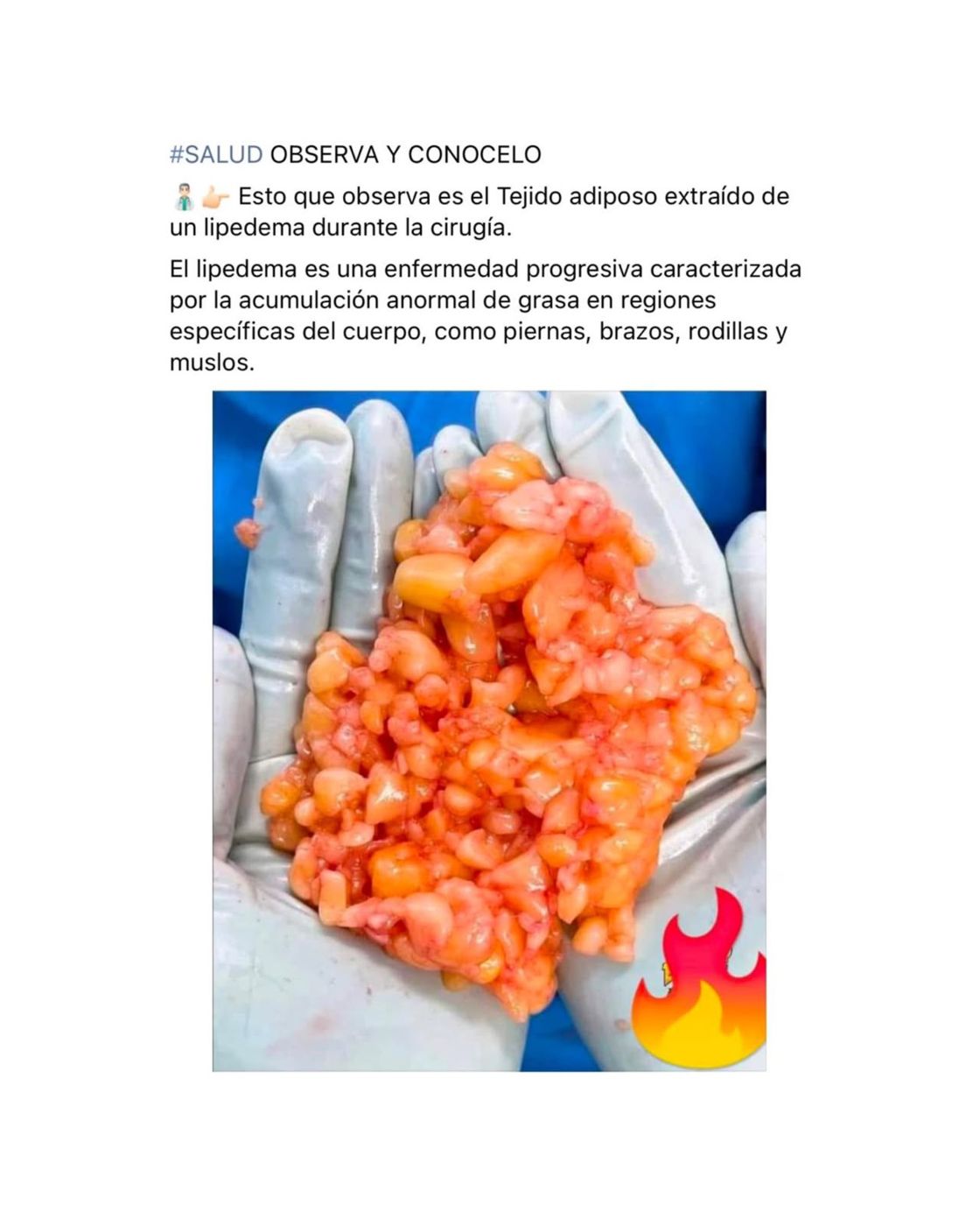 Tejido adiposo extraído de un lipedema durante la cirugía