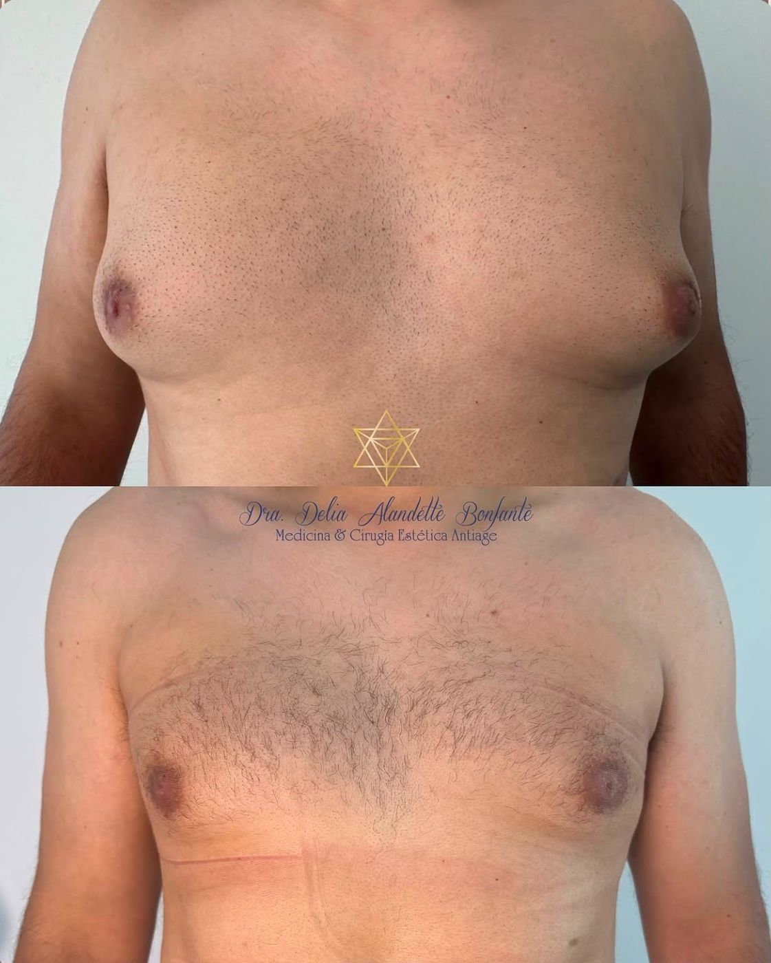 Antes y después de lipo de pectoral en hombre