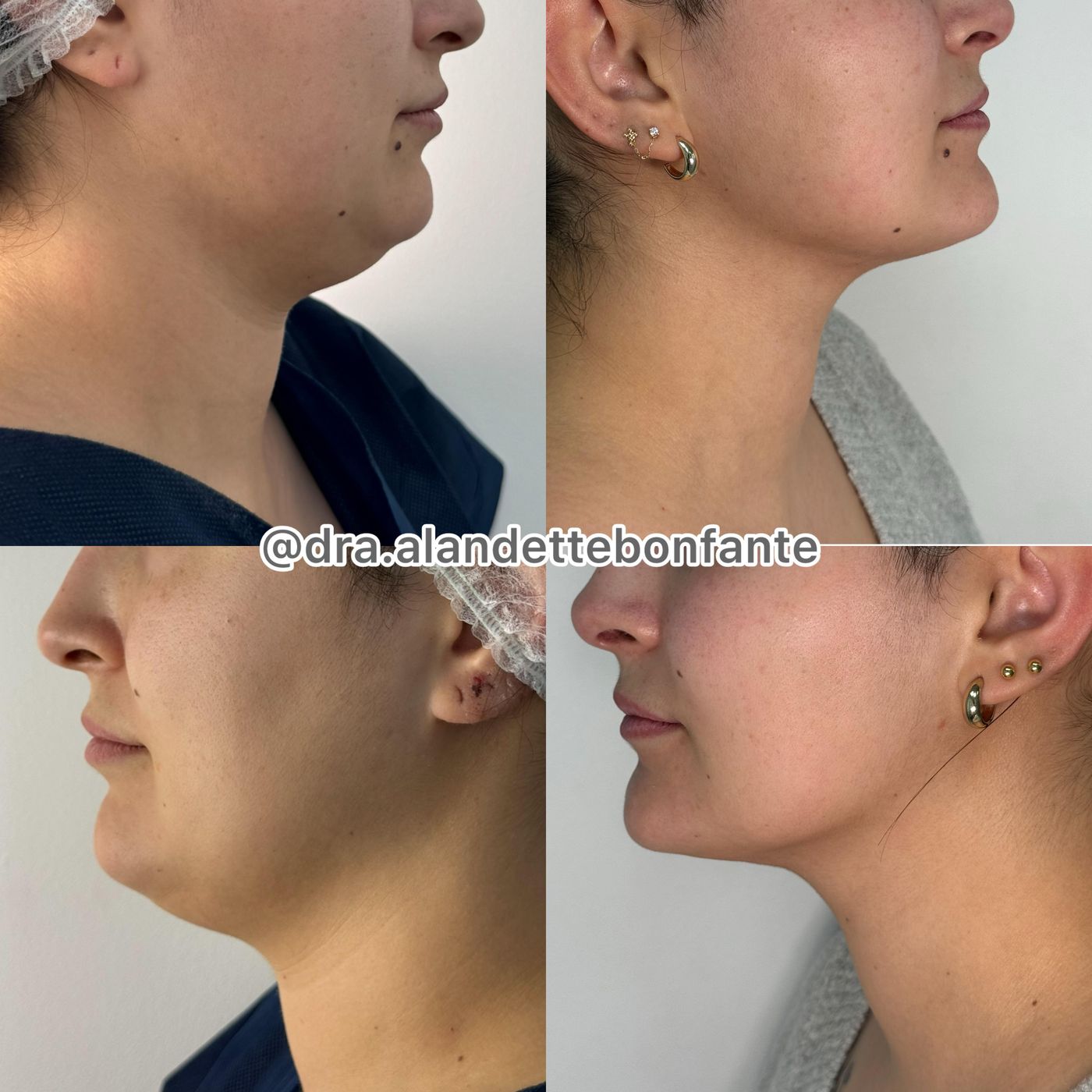 Antes y después de lipopapada
