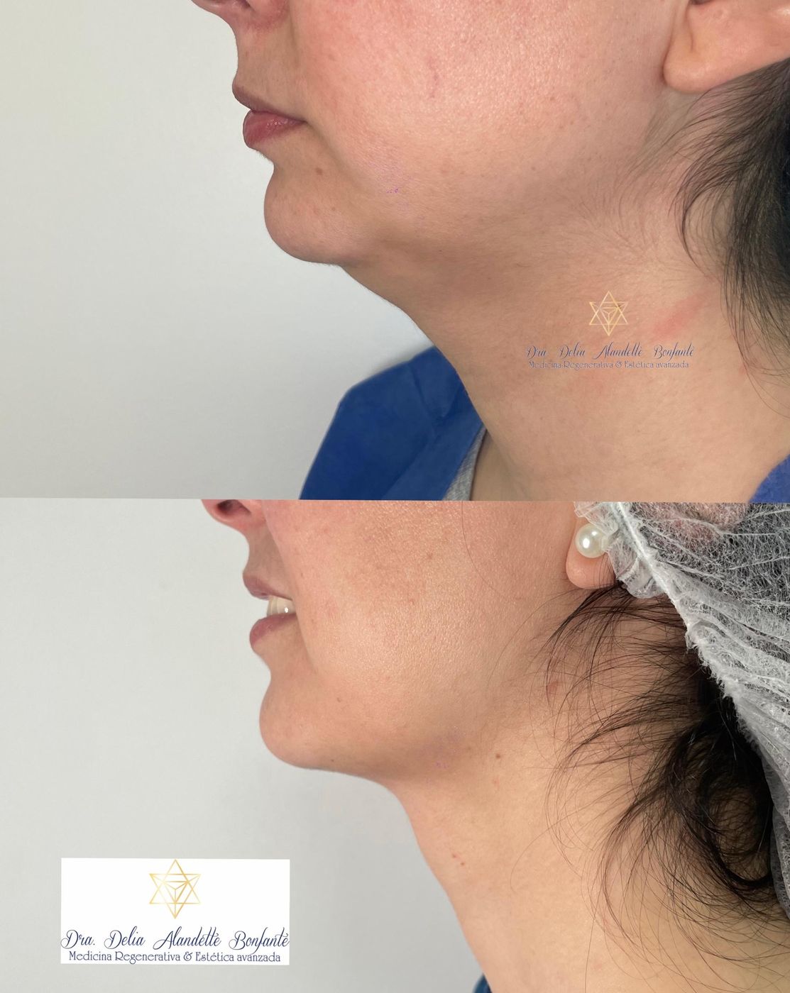Antes y después de lipopapada, contorno mandibular