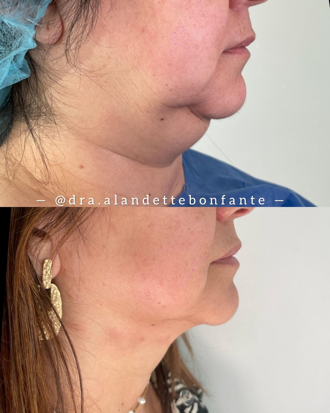 Antes y después de lipopapada