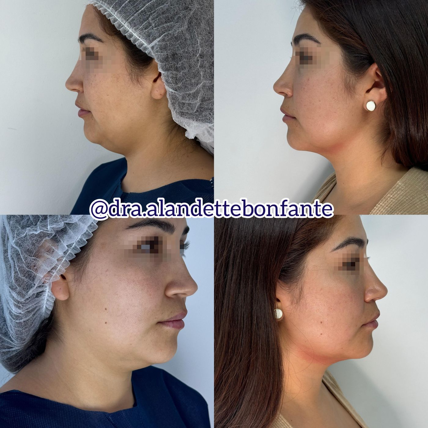 Antes y después de lipopapada