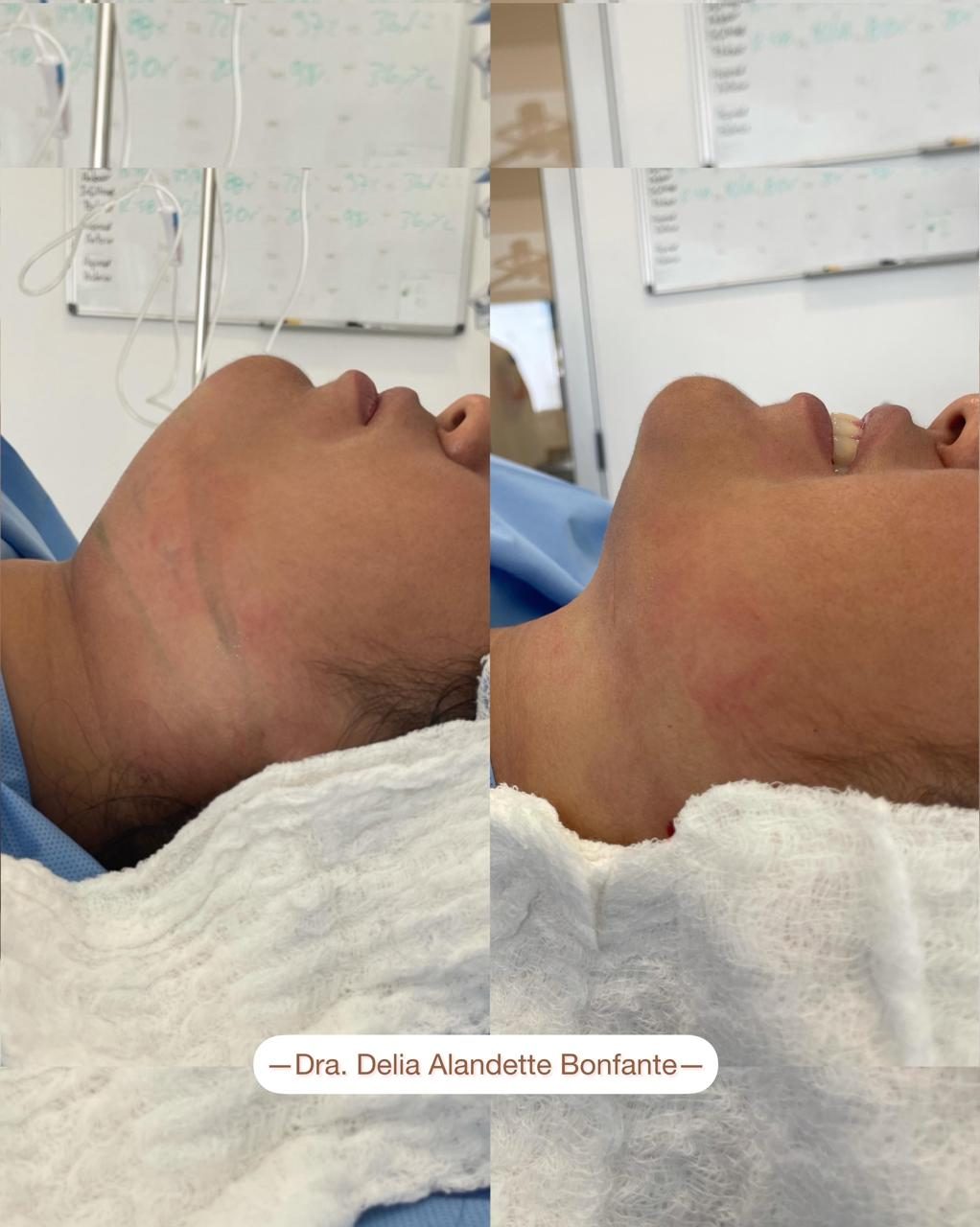 Antes y después de lipopapada, perfil