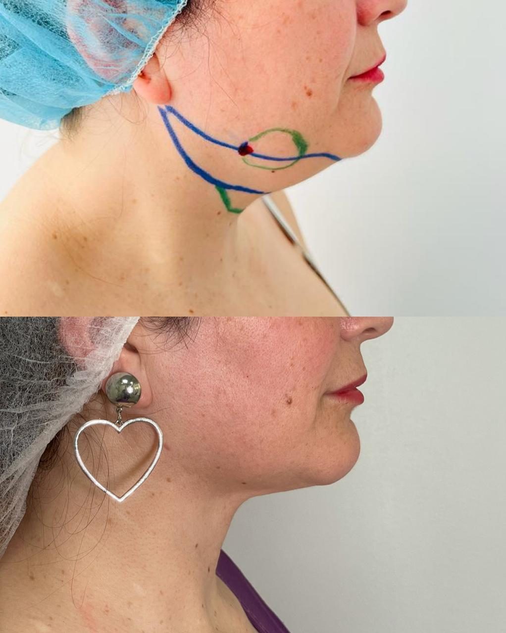 Antes y después de lipopapada, con la marcación previa