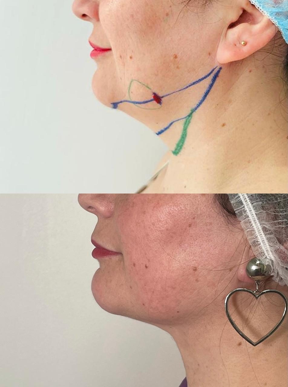 Antes y después de lipopapada, lado opuesto con la marcación previa