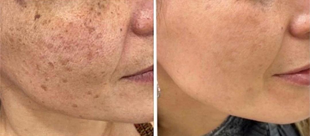 Antes y después de tratamiento para manchas en la mejilla