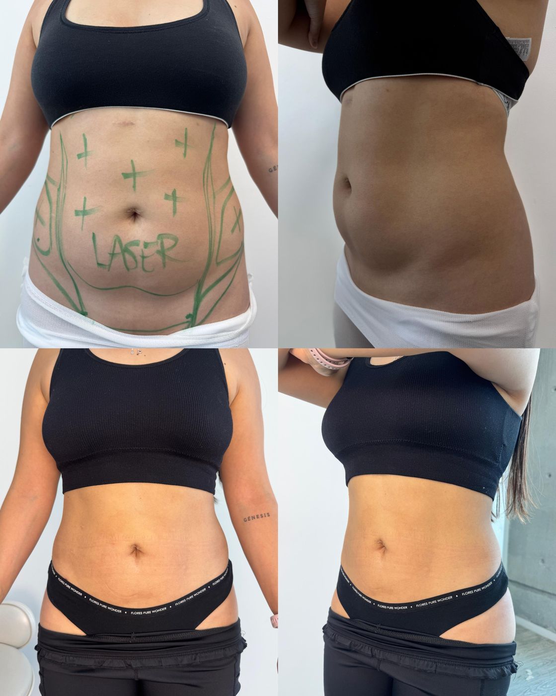 Antes y después de MELA de abdomen y flancos