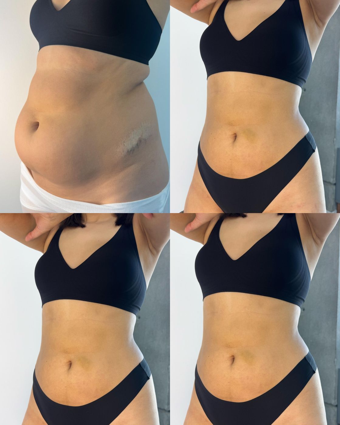 Antes y después de MELA de abdomen, vista lateral
