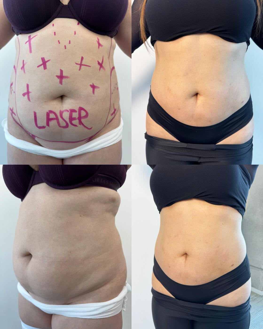 Antes y después de MELA de abdomen