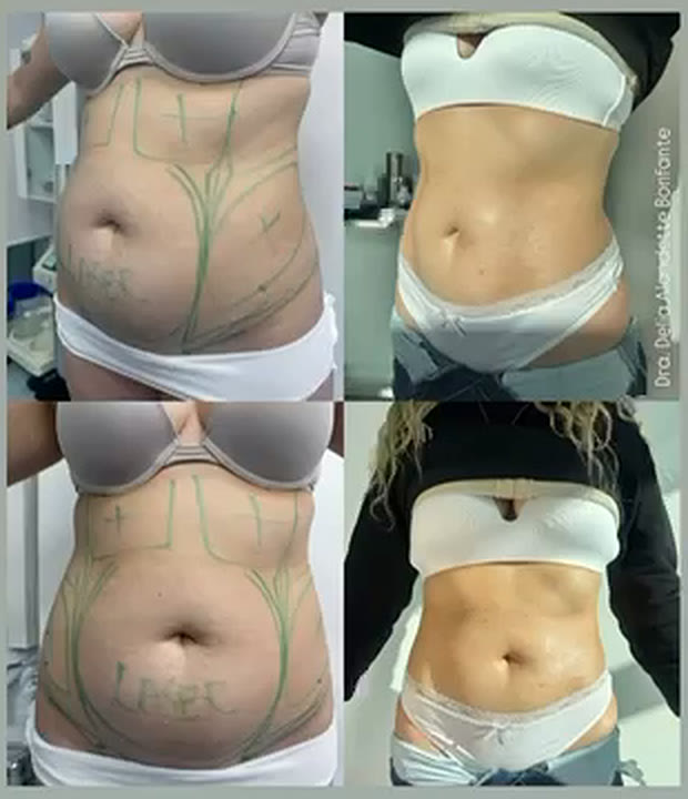 Antes y después de MELA de abdomen, dos vistas