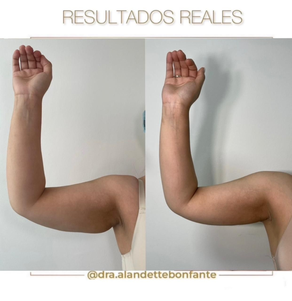 Antes y después de MELA de brazos