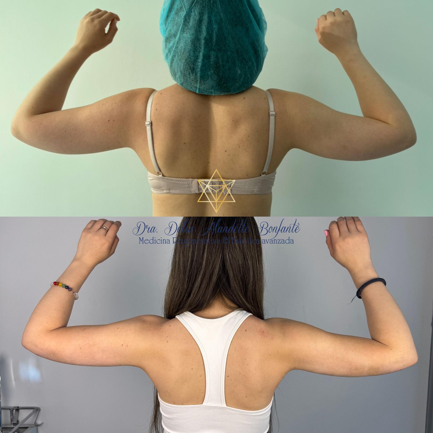 Antes y después de MELA de brazos, vista posterior