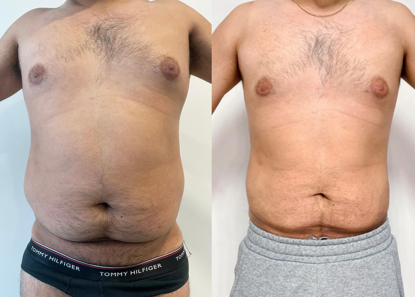 Antes y después de un paciente del programa METABOLIC Control