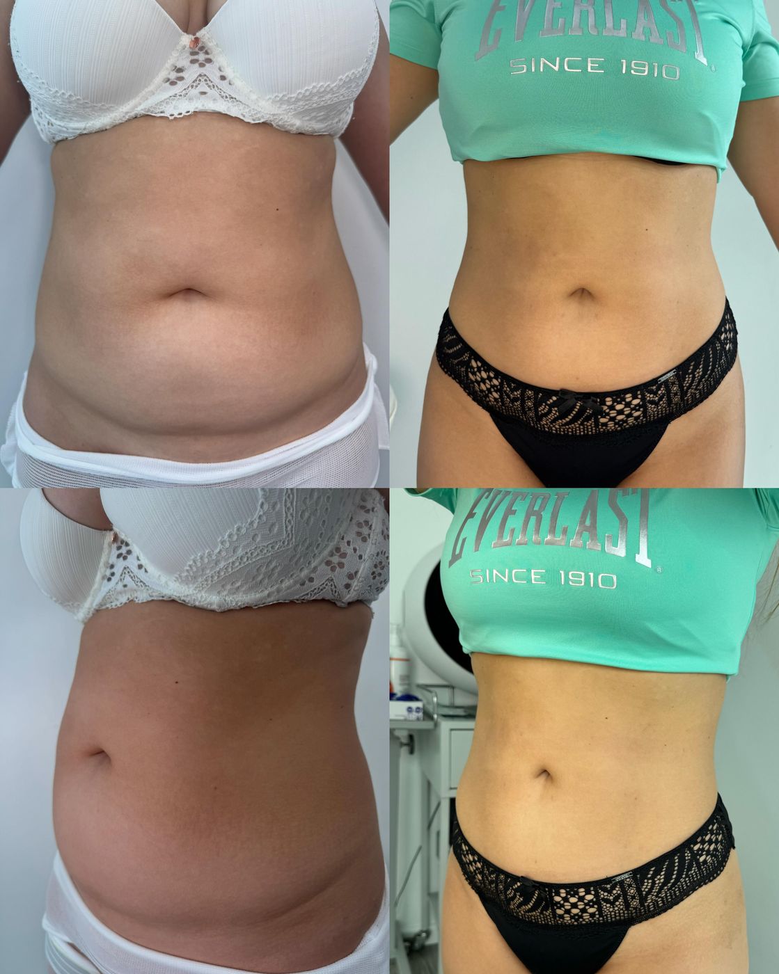 Antes y después de minilipo de abdomen