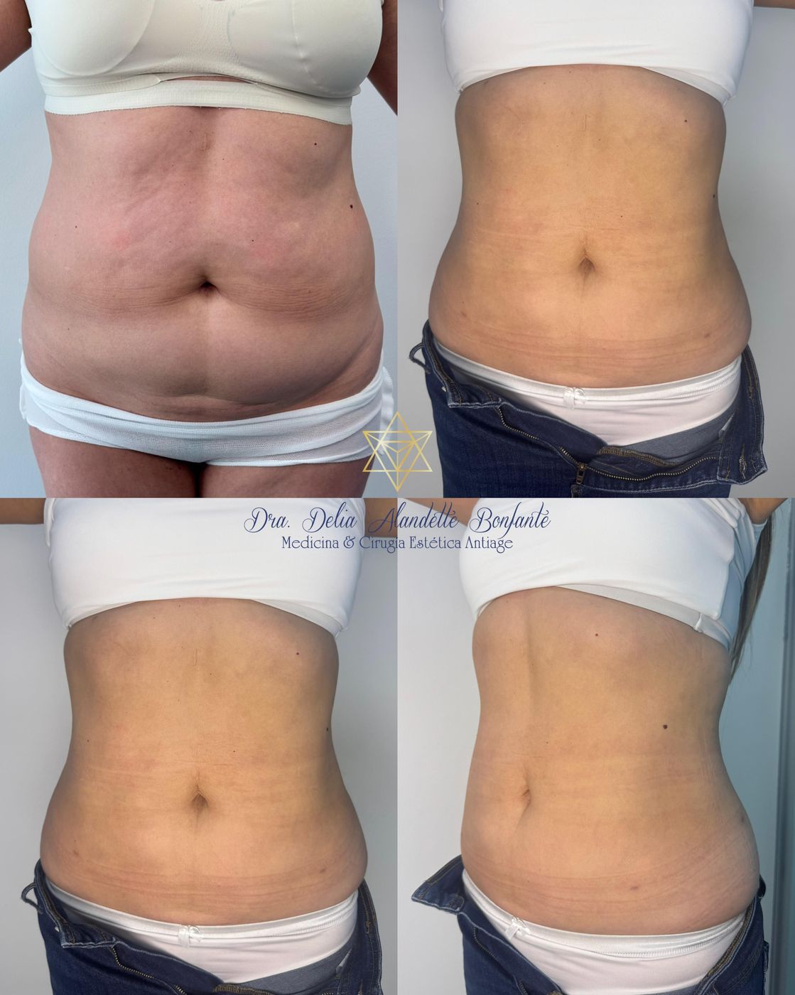 Antes y después de minilipo de abdomen y cintura