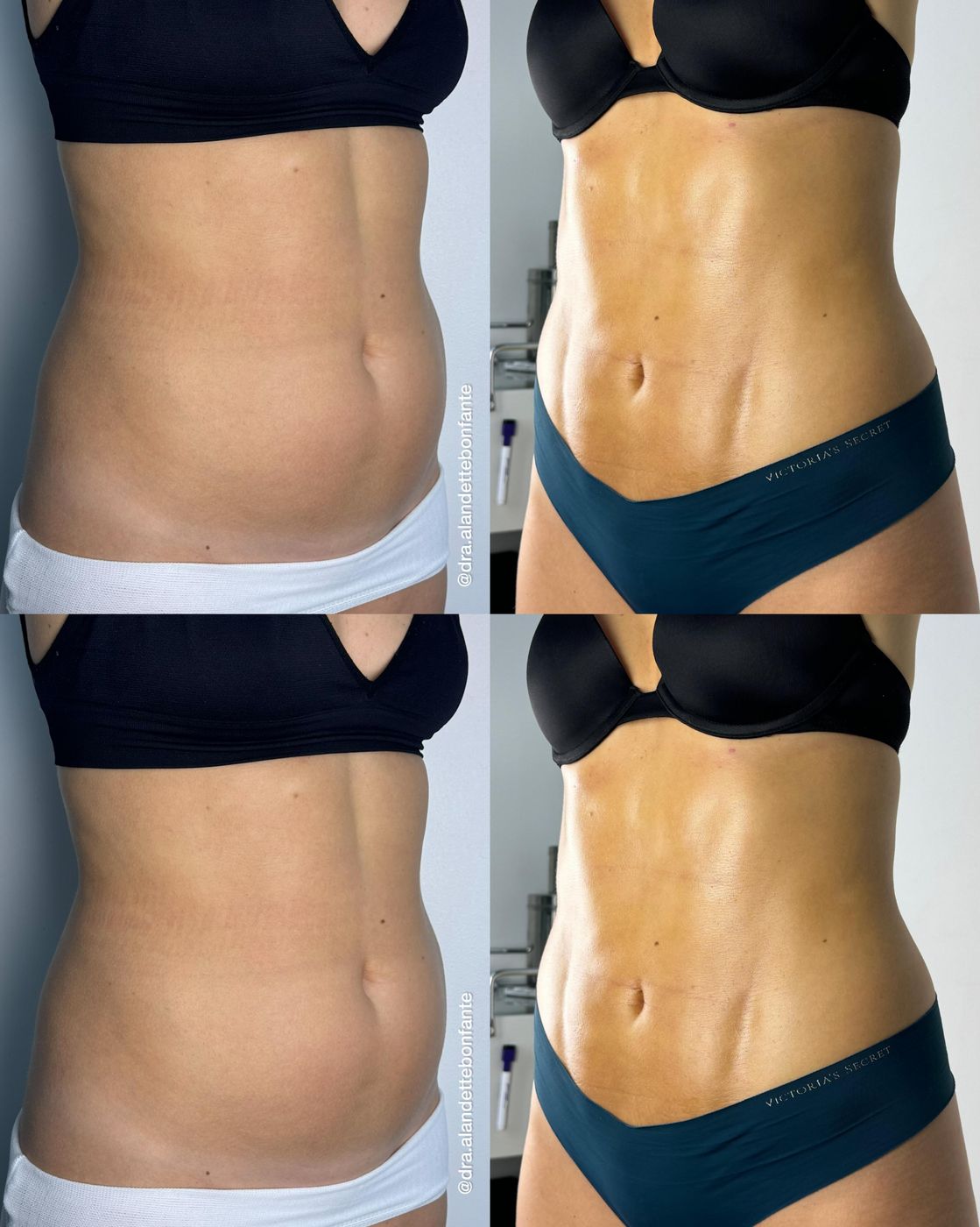 Antes y después de minilipo de abdomen