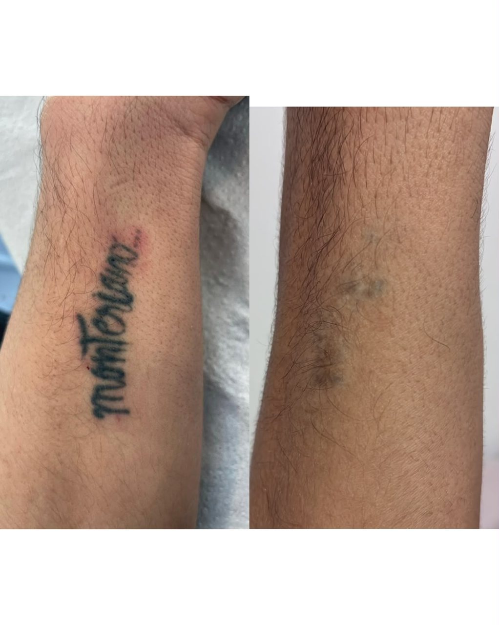 Antes y después de retiro de tatuaje con láser