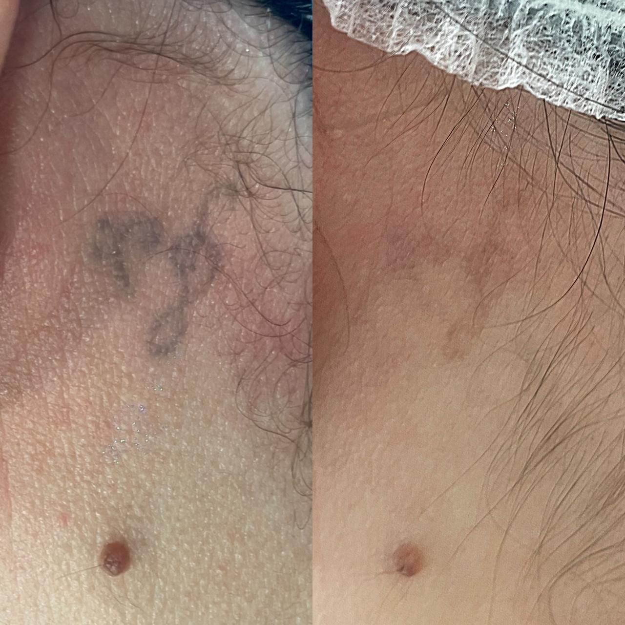 Antes y después de retiro de tatuaje con láser