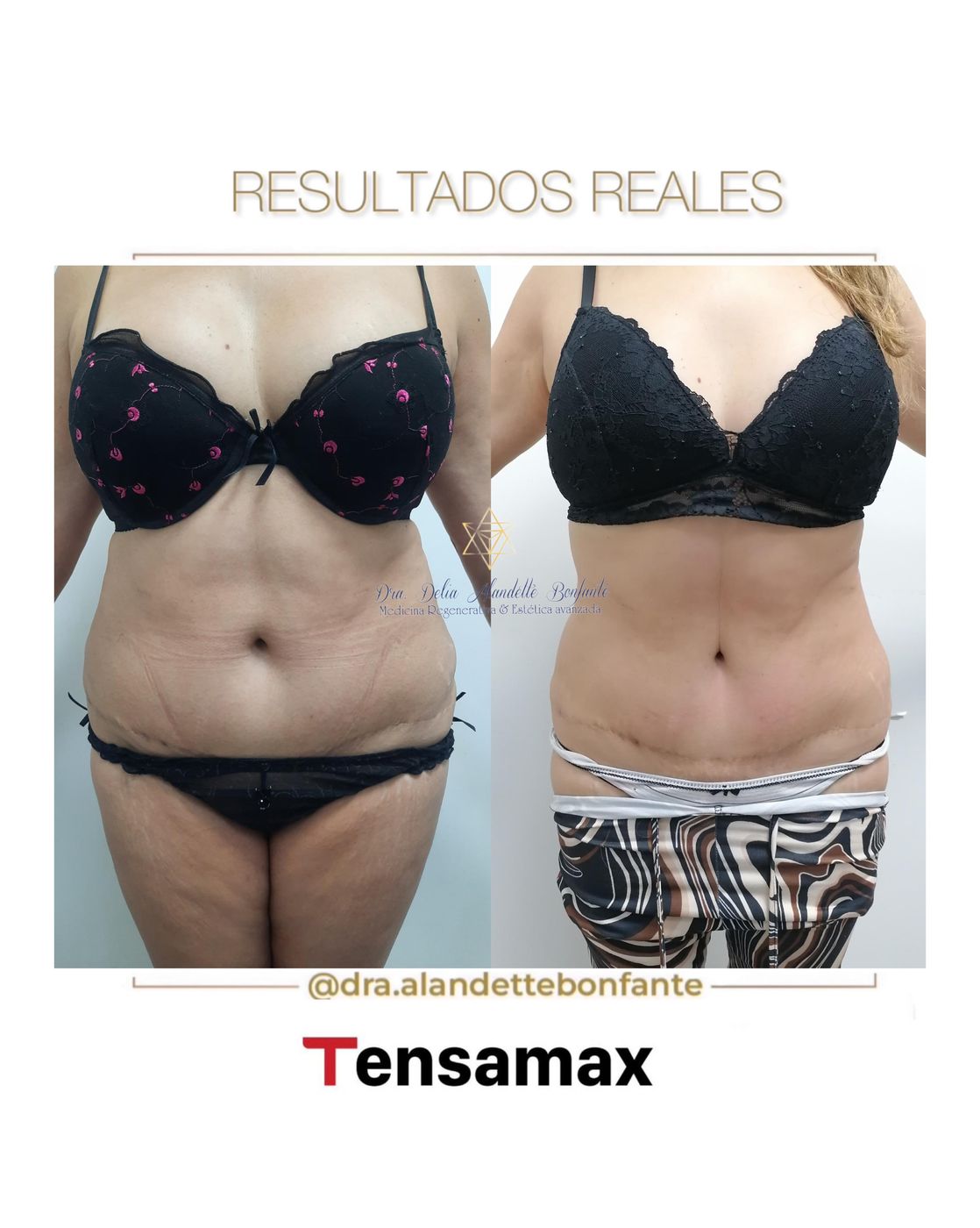 Antes y después de tratamiento con TENSAMAX