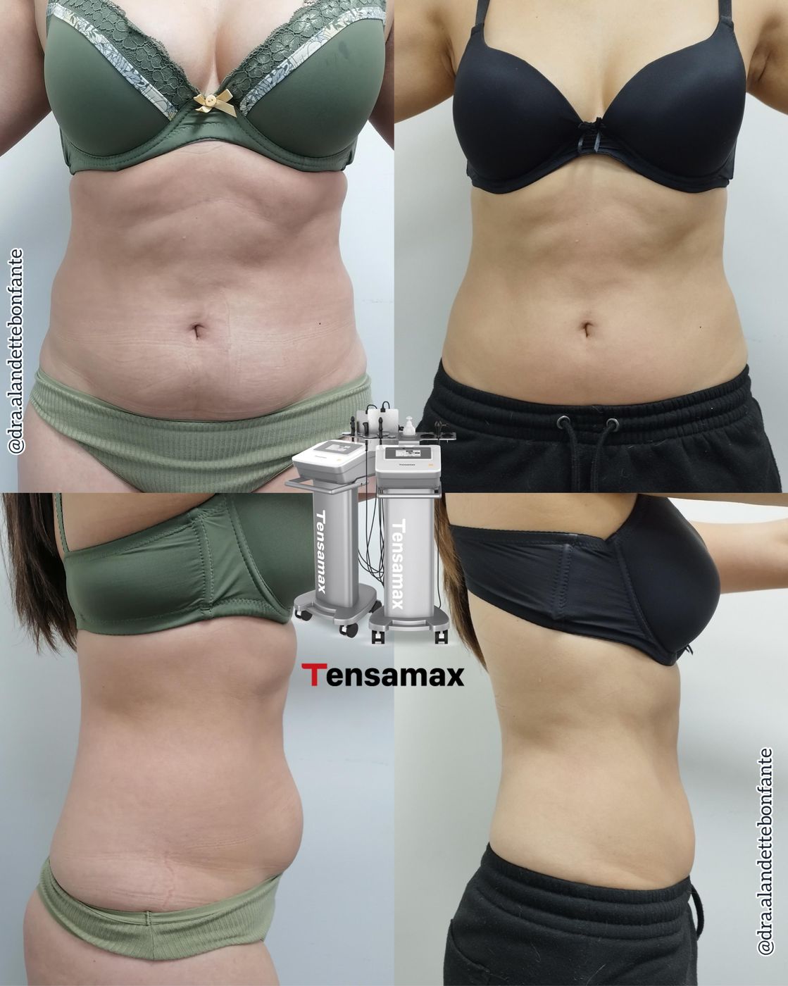 Antes y después de tratamiento con TENSAMAX
