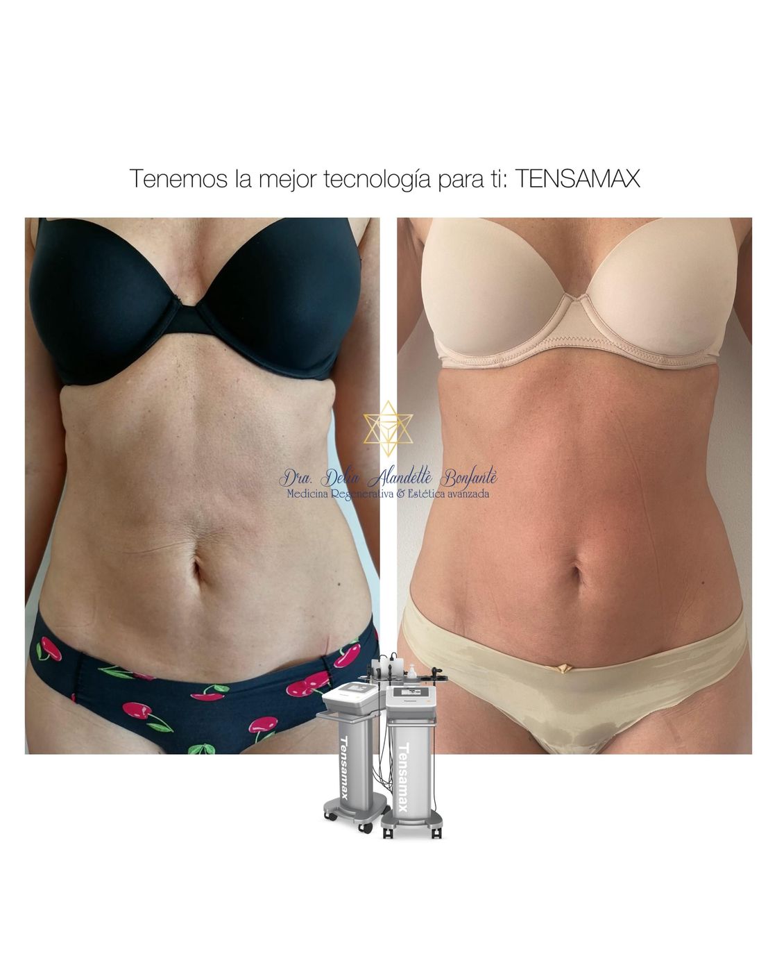 Antes y después de tratamiento con TENSAMAX